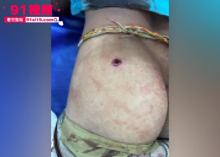 泰国军方空袭柬埔寨导致平民受伤 数万民众流离失所 两国新一轮冲突爆发 - 图15