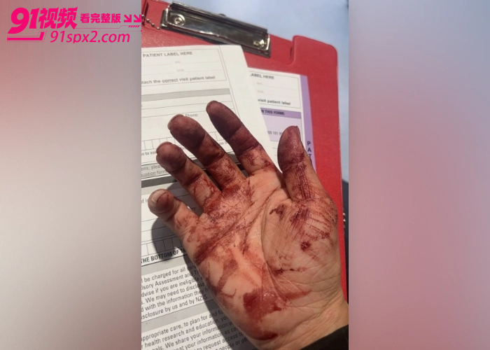 东方会喷火的龙 神不在新西兰 直播时手机被抢遭十余人暴力围殴 鼻子骨折满脸是血 现场视频流出引发热议 - 图16