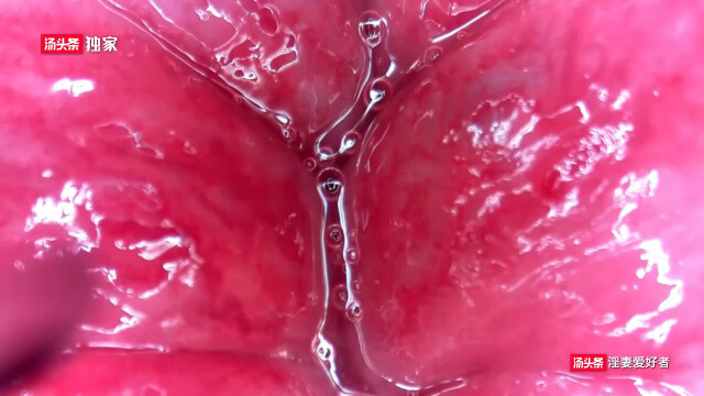 跟随内窥镜看看菊花里的小痔疮