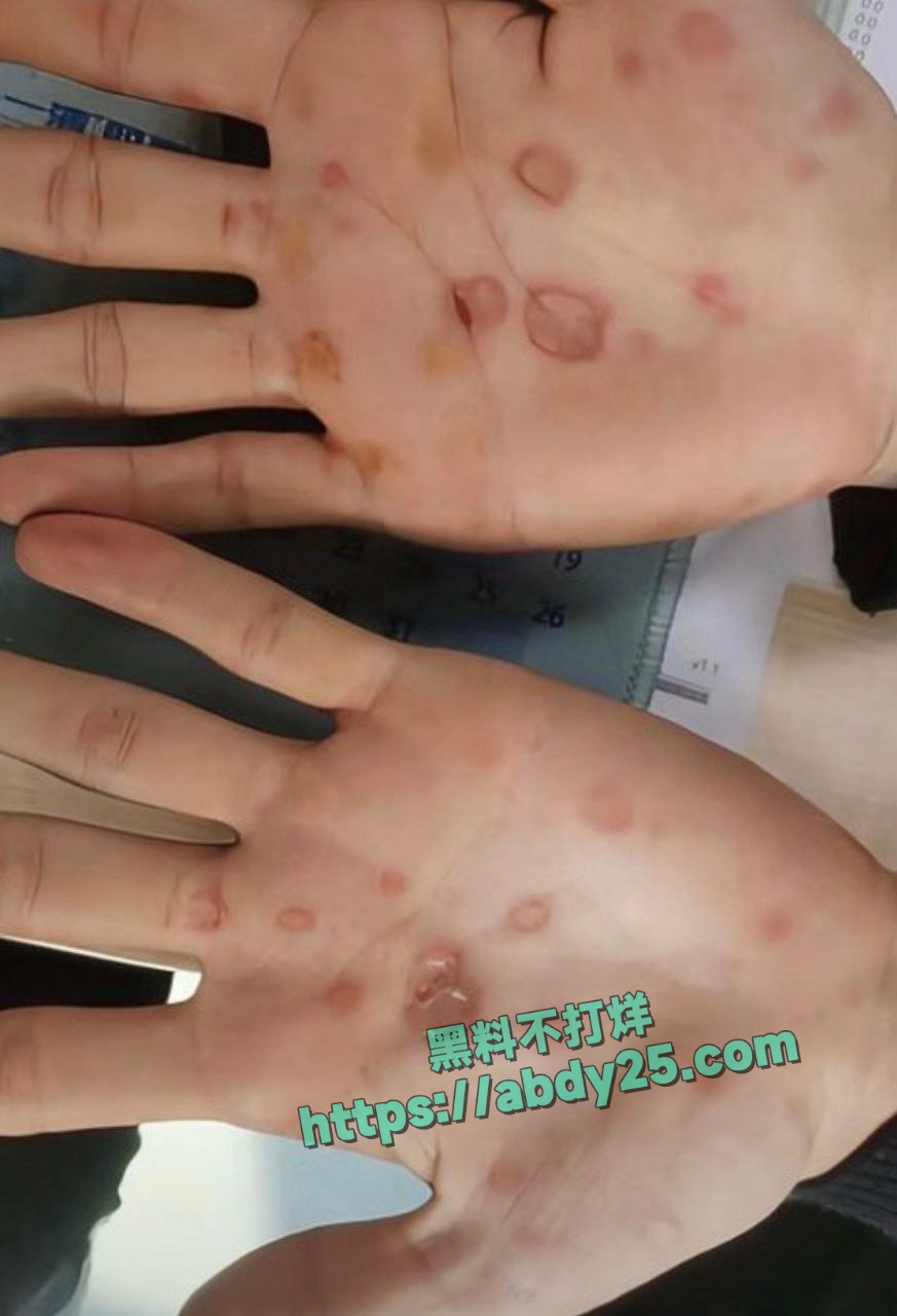 网红起床了小澈梅毒感染 36