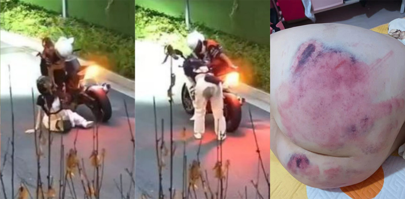 爆笑奇葩事件！女子乘坐摩托车后座掉到车轮上 屁股被严重烫伤！