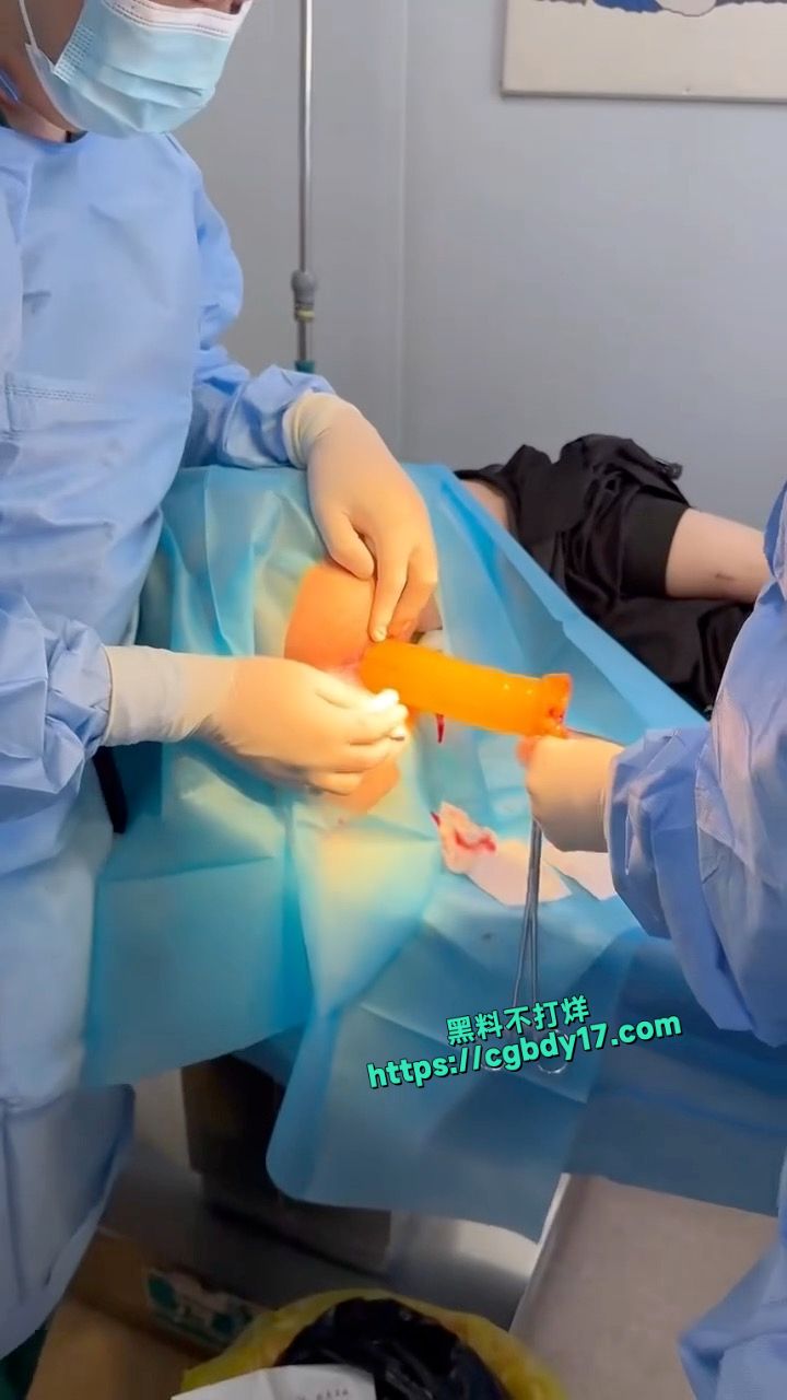 男子将超大号橡胶棒塞进肛门拿不出来4