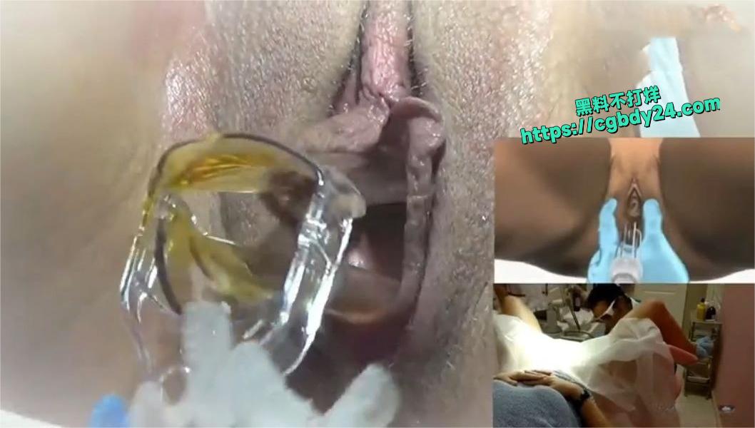阴道阴唇紧缩术1
