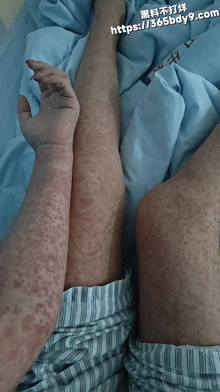 广州基孔肯雅热3