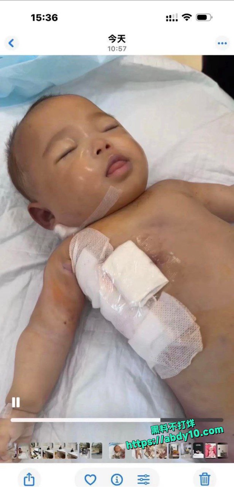 宁波小洛熙术后死亡原因 10
