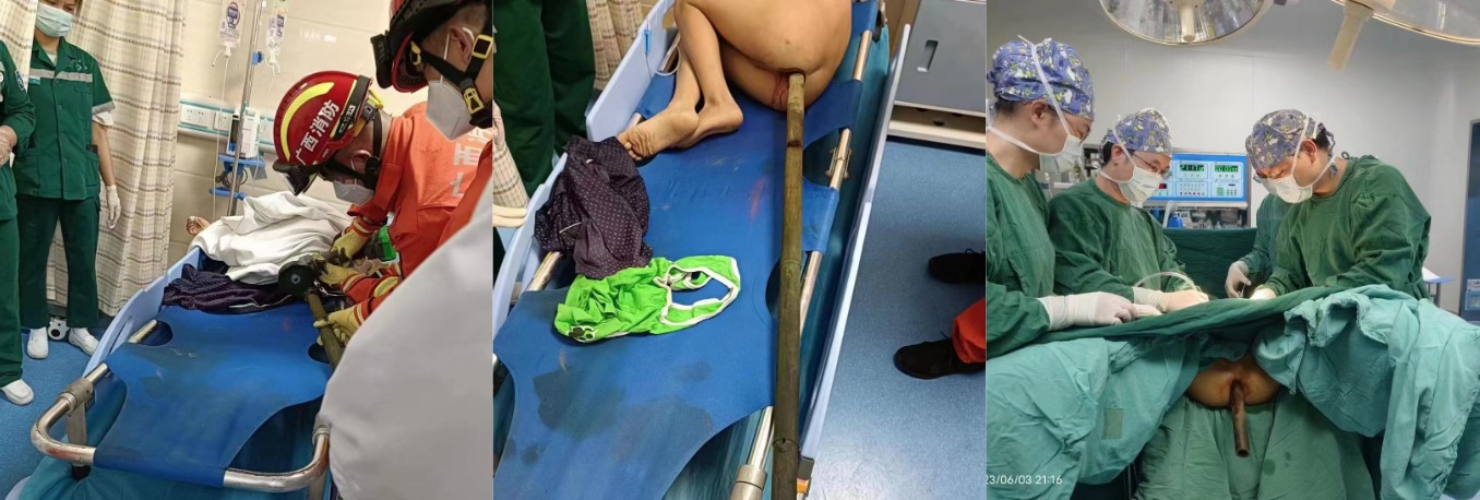 野外跳水有风险！广西一男孩因臀部被竹竿插入约6英寸而被紧急送往医院