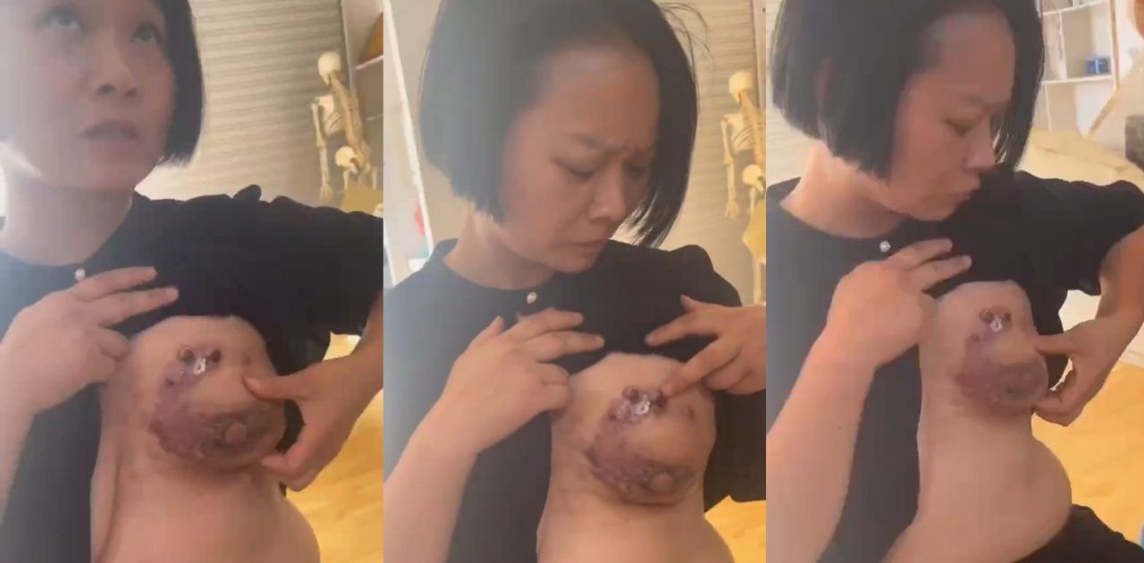短发美女的奶子中毒溃烂了 快来个懂医术的瓜友看一看 这个奶子还有救吗