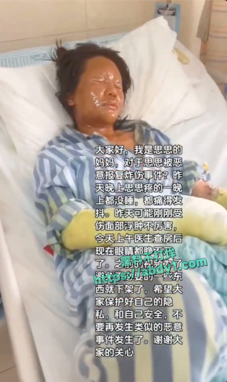 湖南女主播思思收到神秘炸弹快递遭严重炸伤面部毁容 4