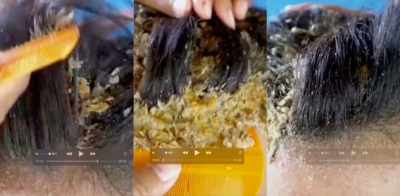 又恶心又解压 用篦子刮下万年头皮屑 解压程度堪比修牛蹄