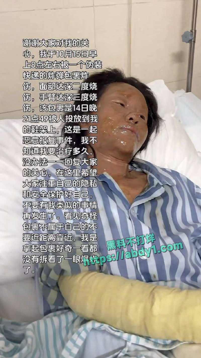 湖南女主播思思收到神秘炸弹快递遭严重炸伤面部毁容 2