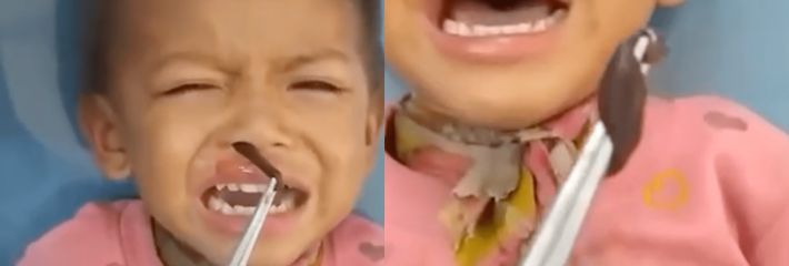 猎奇视频医生从小孩的鼻子里夹出一根虫 不知道到是水蛭还是啥