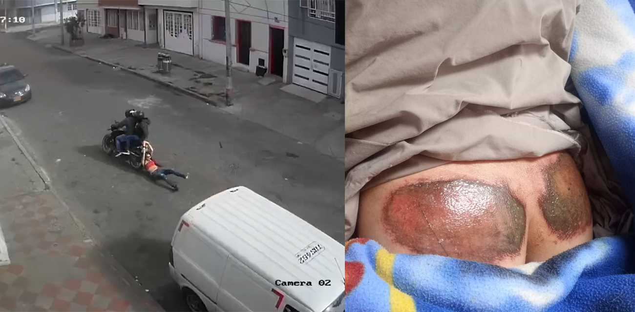 哥伦比亚波哥大 飞车党将女子拖了几个街区 以抢走她的钱包 好好的屁股都毁了
