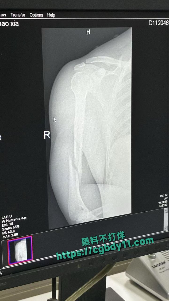 肌肉男 掰手腕 把手掰断了3