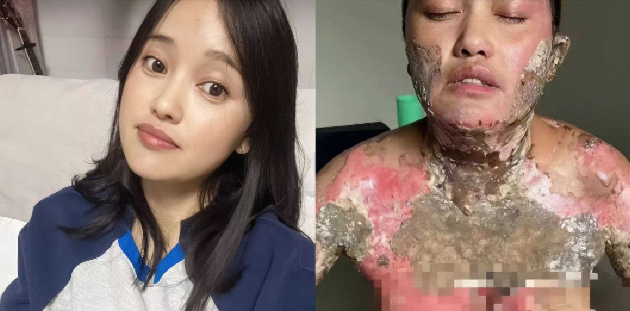 四川凉山一女子称被丈夫家暴后泼白酒点火，导致大面积烧伤，画面可能引起不适，慎入！