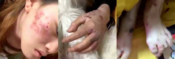 恶心慎点！河南信阳啤酒森林查出阳性 妹子全身溃烂 甚是吓人！这是hiv还是梅毒？
