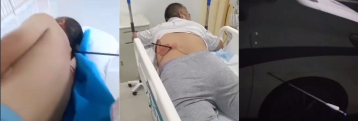 山东临沂突发弓箭伤人事件 复合弓射手躲在楼梯间射杀路人 就连警车也遭殃！