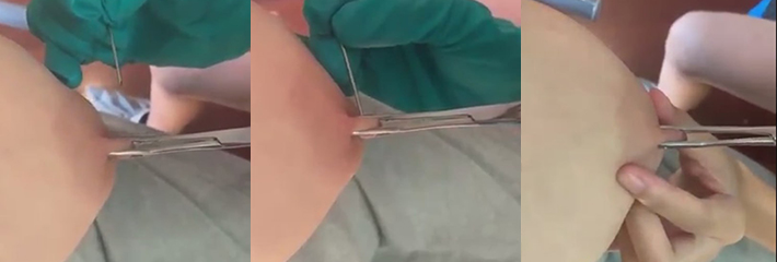 乳头穿孔特写视角 看着就疼 以后还能喂奶吗?