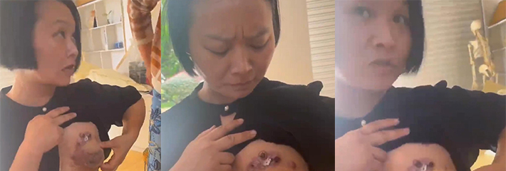 奶子中毒了 这是很么病 快来个懂医术的瓜友讲讲 这个奶子还有救吗？