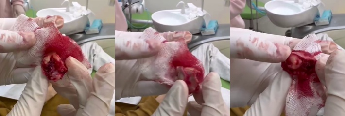重口慎点 牙科诊所拔智齿 医生用力过猛将上颚骨一同拔出 隔着屏幕都能感受到巨痛
