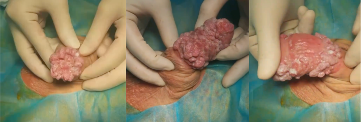 重口慎点！一酒吧女身患三期梅毒传染一男的 中了逼毒的晚期症状给看吐了！