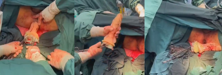 重口慎入！这哥们屁眼里掏出假屌性具～肛交爆菊拿不出来到医院就医！