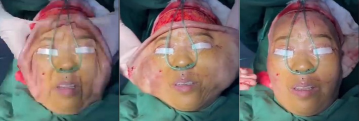 这是你们了解的拉皮手术嘛？小仙女们快来看看，一张脸都快被剐下来了!重口慎入