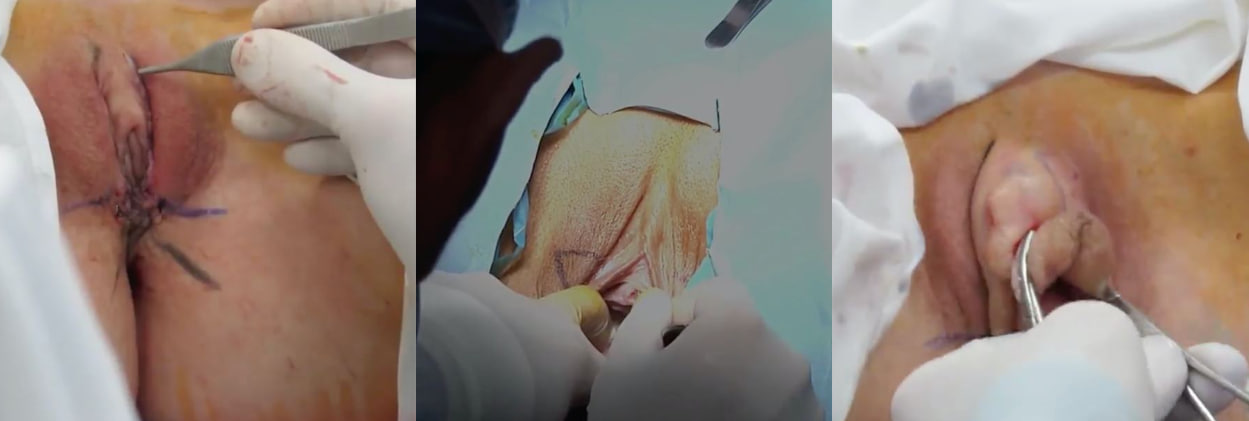 带你见识阴唇整形！阴道缩紧修复处女膜实拍带你满足你的好奇心！带你Get出新知识！