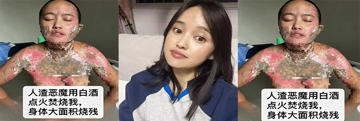 四川凉山女子称被丈夫家暴后被泼酒点火导致自己大面积烧伤，画面可能引起不适，慎入