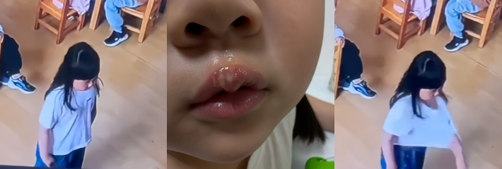 江苏徐州丰县一幼儿园老师 用热熔胶枪烫伤女孩嘴唇 手段残忍引发全网热议