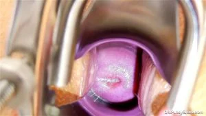 Karen Gyno: Onlyfans, Speculum & Cervix Porn - 经典欧美